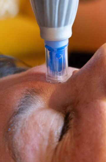 Dermapen Collagen Induction Therapy at Mabin House Nelson