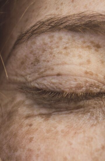 Professional pigmentation assessment consultation
