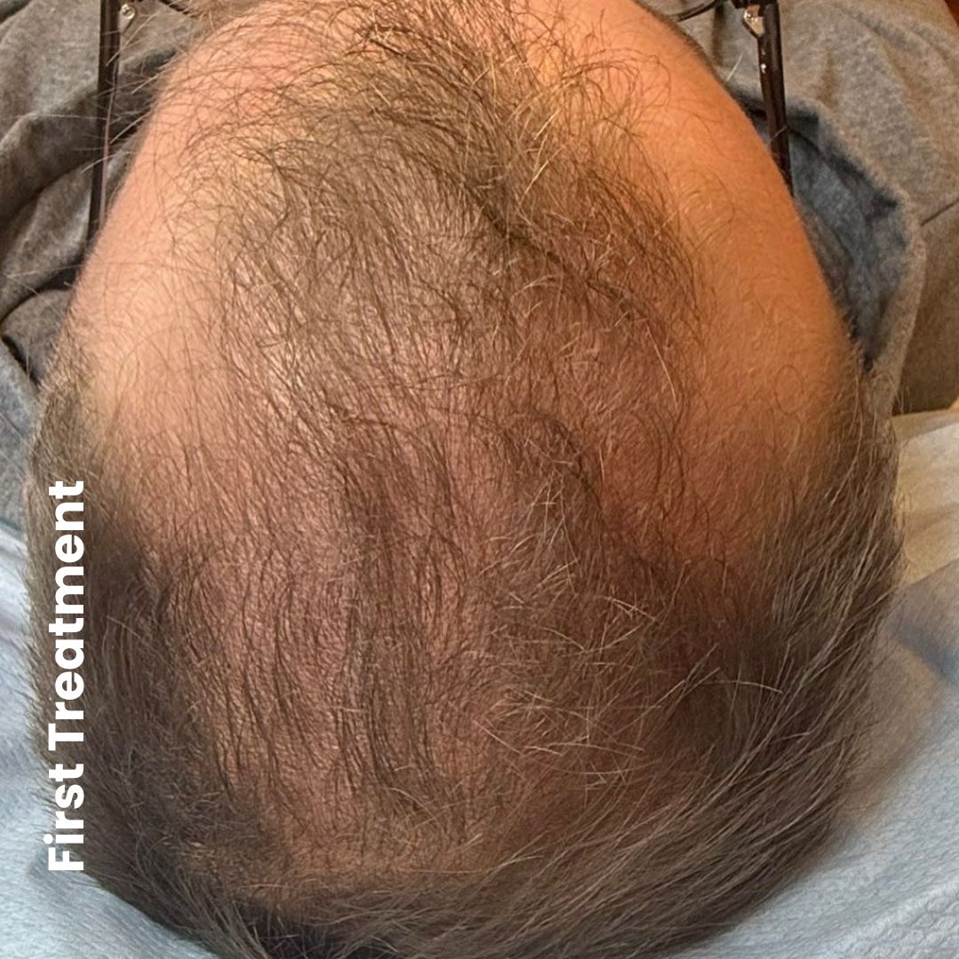 customer testimonial for hair loss treatment in nelson BEFORE