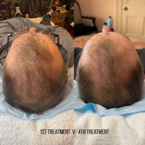 Hair loss treatment